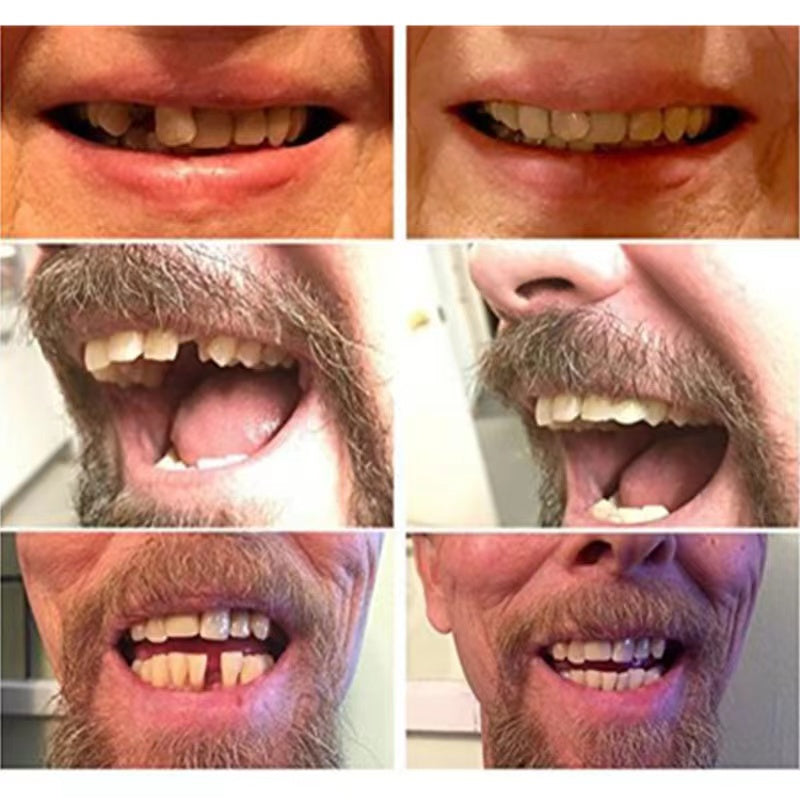 Temporary Cosmetic Tooth Veneer with Heat-Moldable Design and Reusable Application