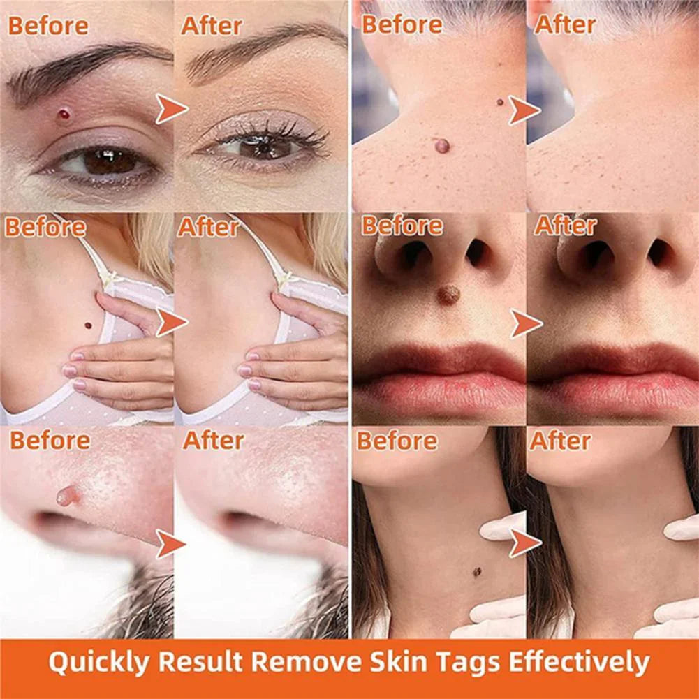 Skin Tag Removal Kit with Dual Spring Sizes and 10-Day Natural Process