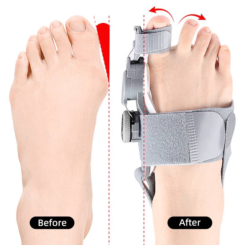 Adjustable Bunion Corrector with Twist Control and Heel Strap Support