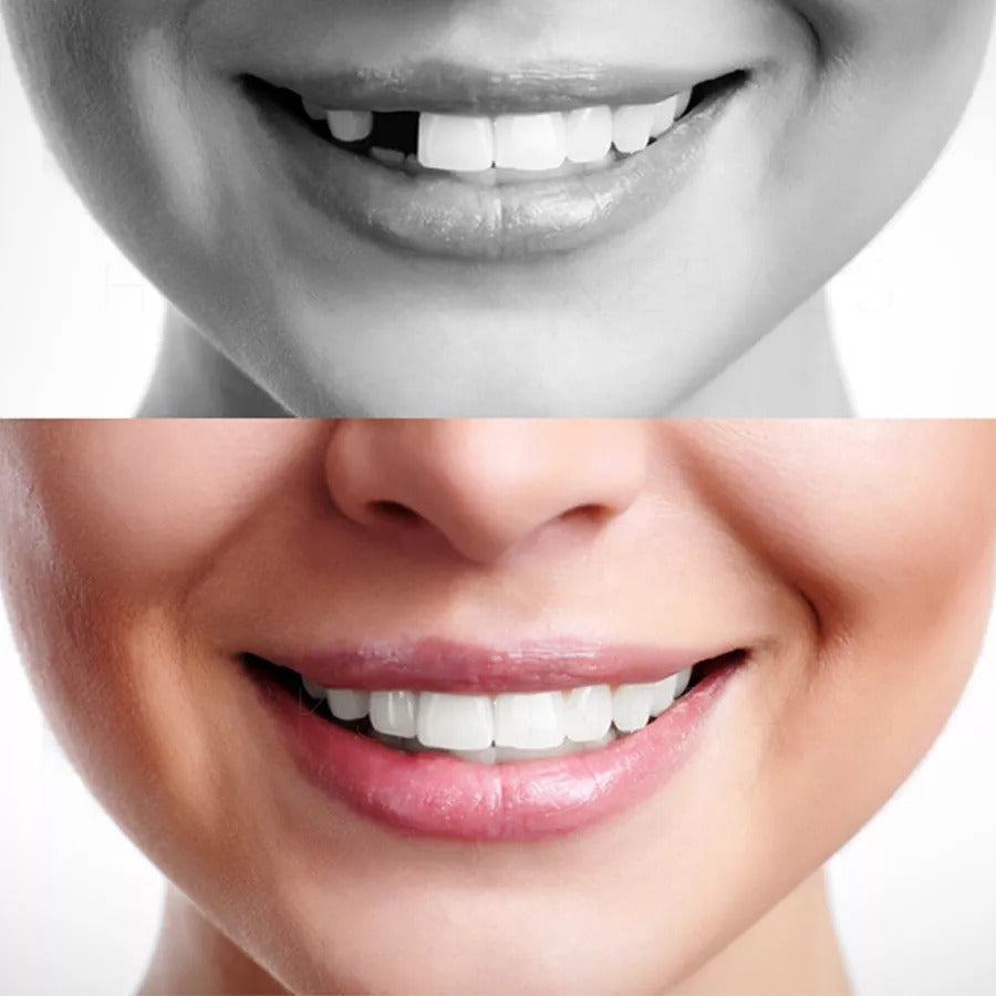 Moldable Polymer Tooth Replacement Kit with Boiling Water Activation and Sandpaper Finishing